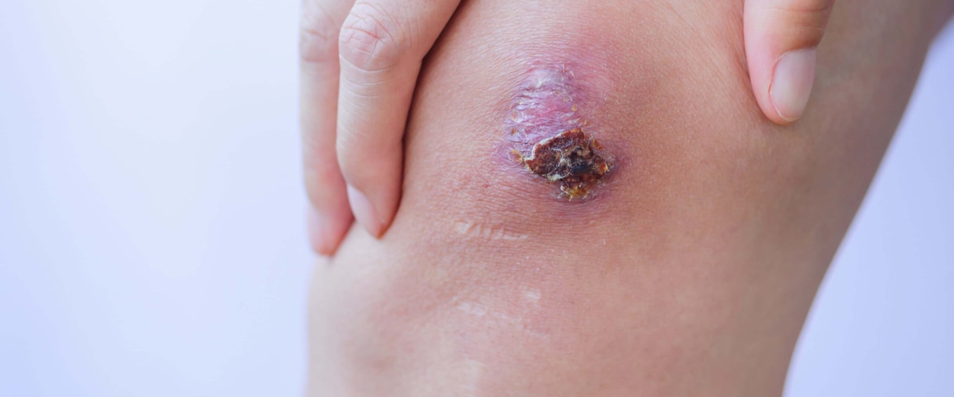 The Importance of Properly Treating and Removing Eschar in Wound Healing