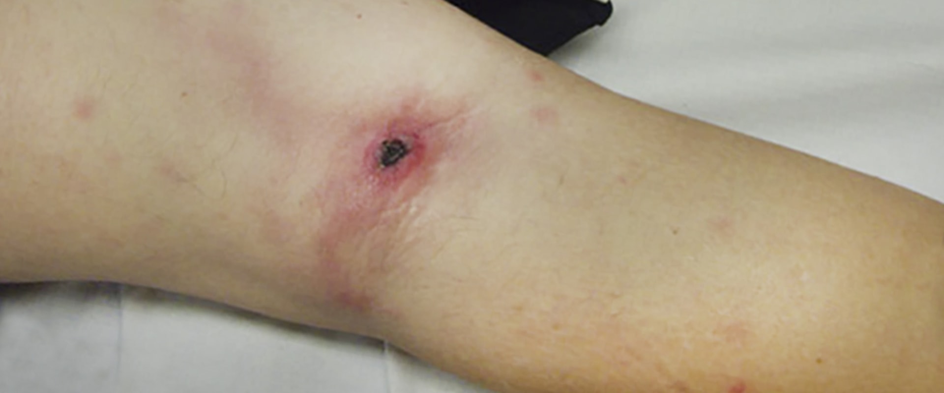 The Importance of Removing Bedsores for Wound Healing