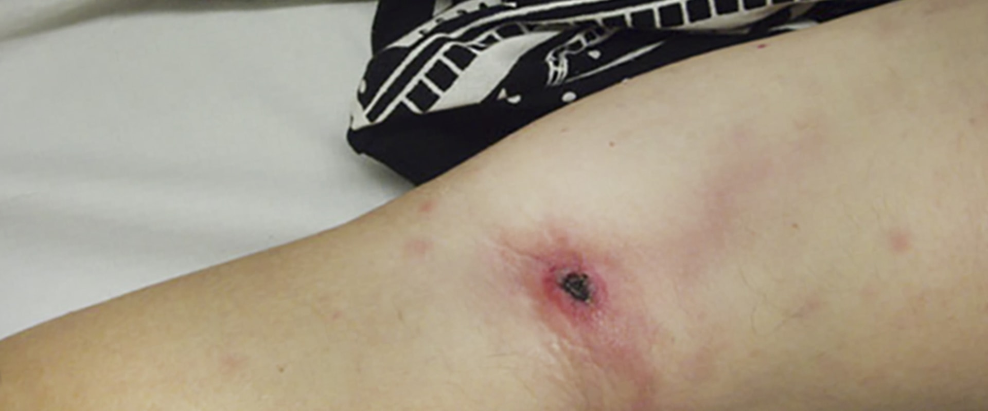 How to Treat Yellow Wound Healing Slough Tissue While Managing Eschar Wounds