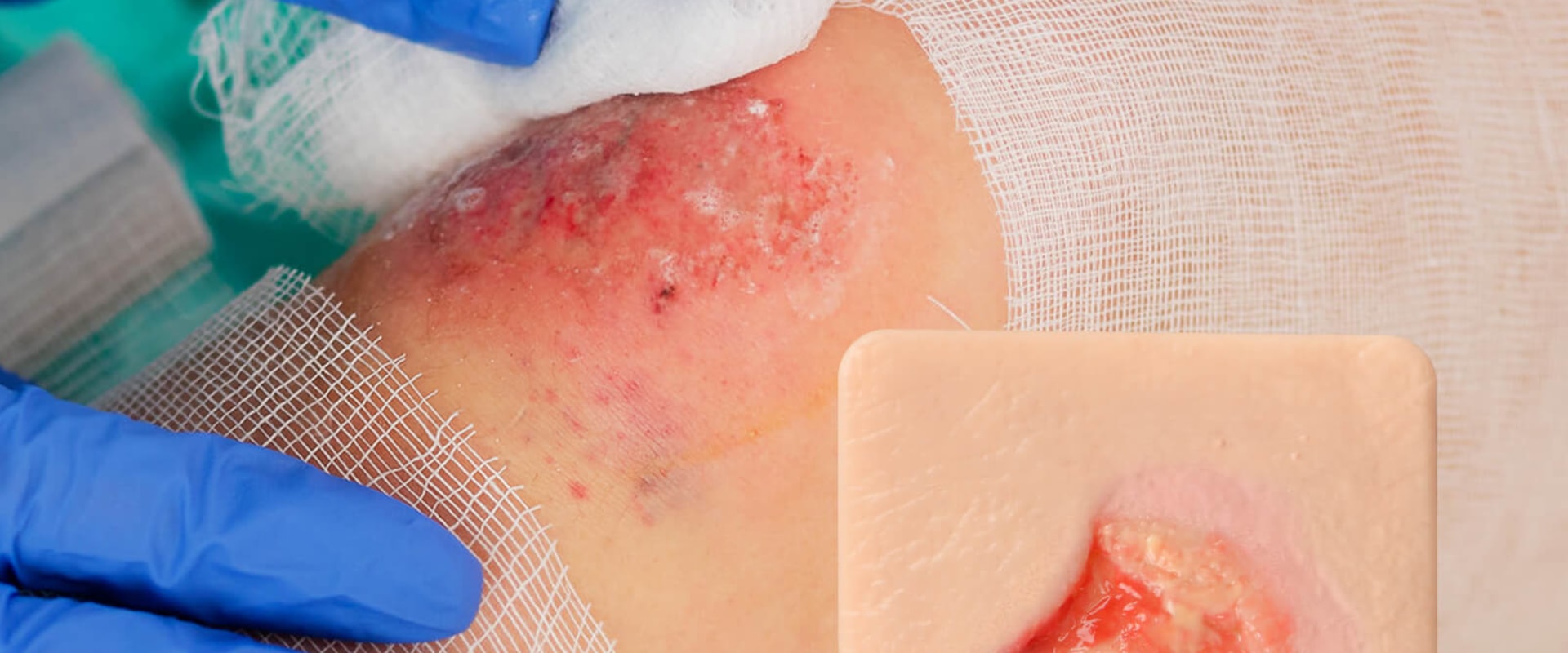 Using Granulation Tissue Wound Pictures for Comprehensive Wound and Eschar Assessment