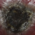 The Importance of Proper Wound Care: Should You Remove Black Eschar?