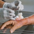 The Role of Debridement in Wound Care