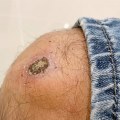 The Healing Process of Scabs and Sores