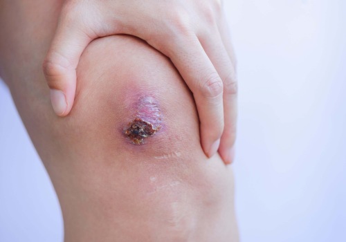 The Importance of Properly Treating and Removing Eschar in Wound Healing