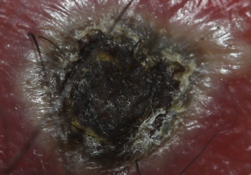 The Importance of Proper Wound Care: Should You Remove Black Eschar?