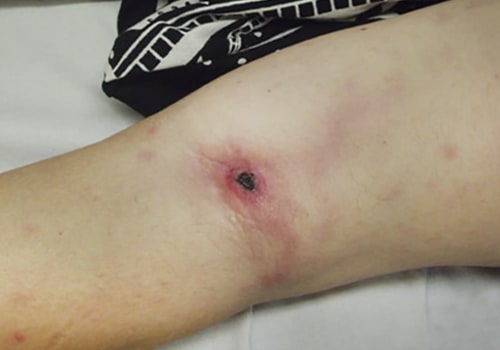 The Importance of Removing Bedsores for Wound Healing