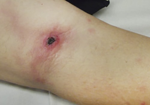 The Importance of Understanding Eschar in Wound Healing