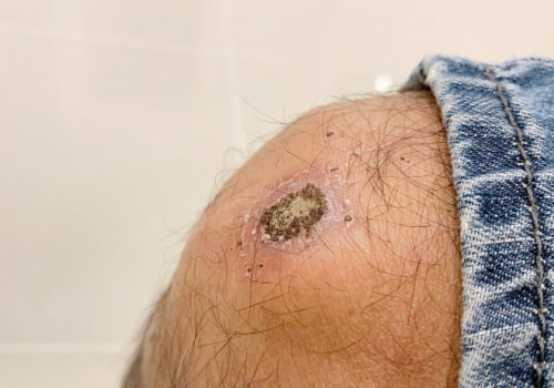 The Healing Process of Scabs and Sores