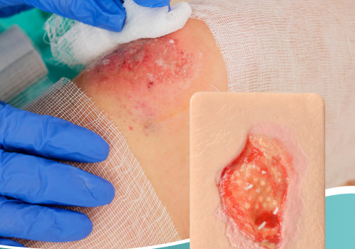 Using Granulation Tissue Wound Pictures for Comprehensive Wound and Eschar Assessment